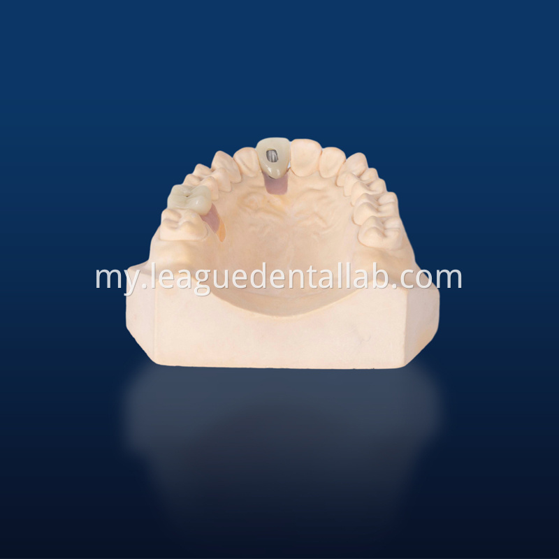 Dental Implant Crown, Dental Implant Zirconia crown,Dental Implant Emax crown,Dental Implant Bridge